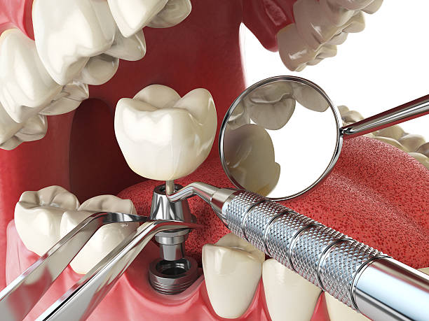 Best Emergency Root Canal Treatment in Beach Park, IL